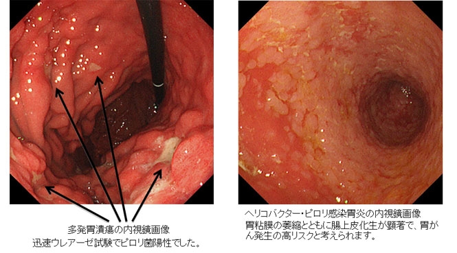 ヘリコバクターピロリ菌