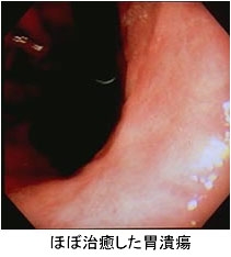 ●胃・十二指腸潰瘍の治療は？