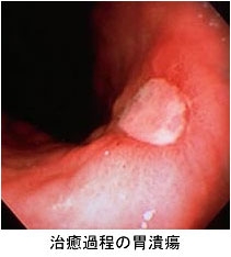 ●胃・十二指腸潰瘍の治療は？