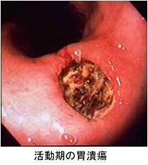 ●胃・十二指腸潰瘍の治療は？