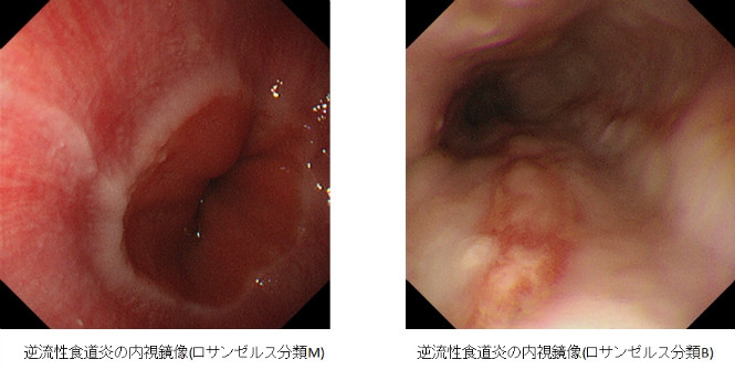 逆流性食道炎