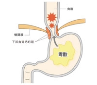 逆流性食道炎