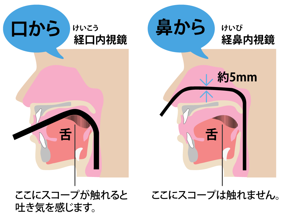 鏡 胃 検査 視 内